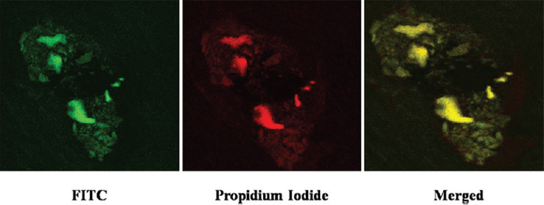 Nuclear localization of cyclin E by confocal microscopy. Cyclin E was labelled by fluorescein isothiocyanate (green) and nucleus was stained with propidium iodide (red) (Magnification ×400). The merged image (yellow-coloured) shows the nuclear localization of cyclin E.
